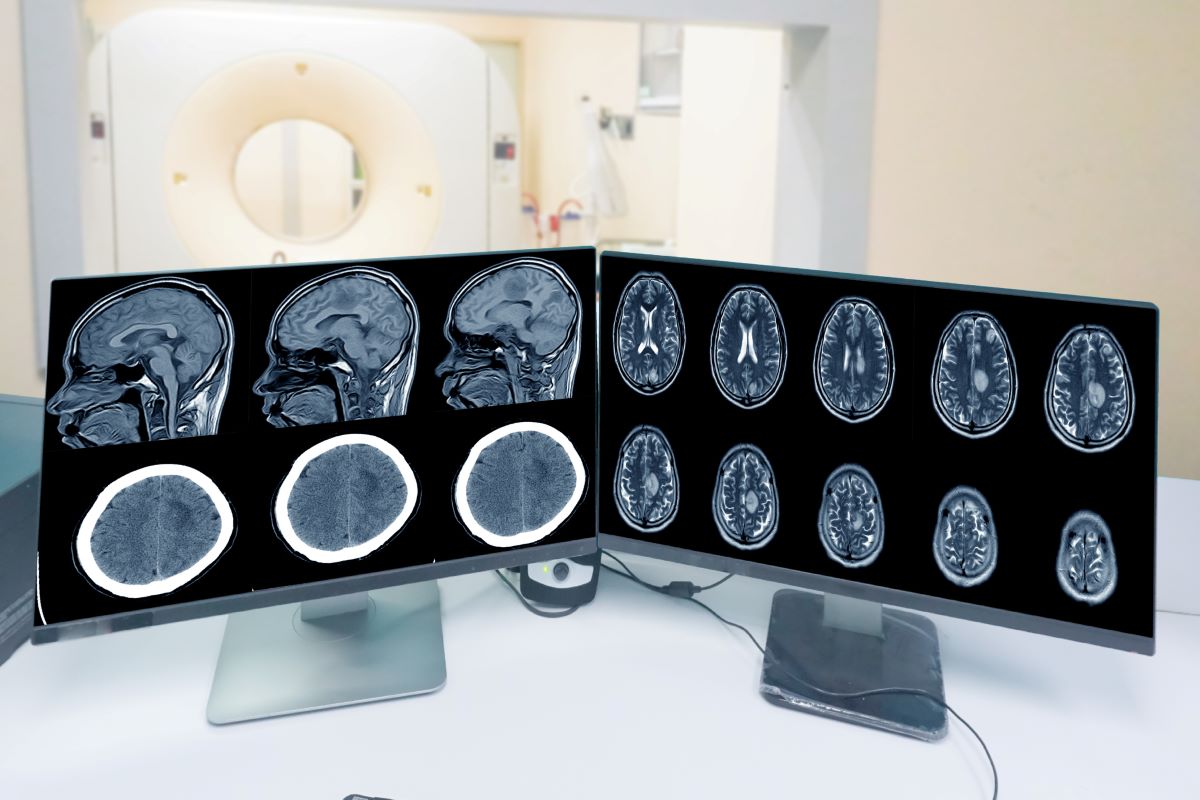 Meningioma